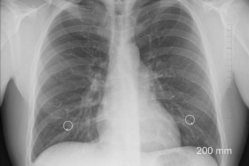 Foto: Plzeňští plicní lékaři odhalili v kraji 33 nemocných 