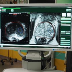 Nová technologie urologů FN Plzeň zachytí nádor přesněji 