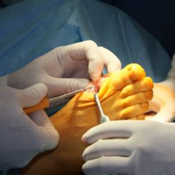 Jednodenní chirurgie Privamed už operuje deformace prstů 