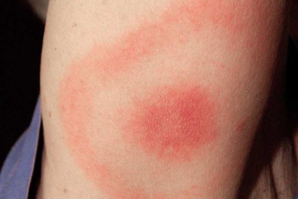 Výskyt klíšťových nemocí na Vysočině: borelióza výrazně roste, encefalitida mírně klesá