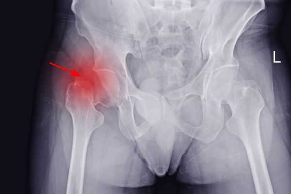 Stodská nemocnice otevírá novou ambulanci. Pomůže odhalit tichého zloděje kostí