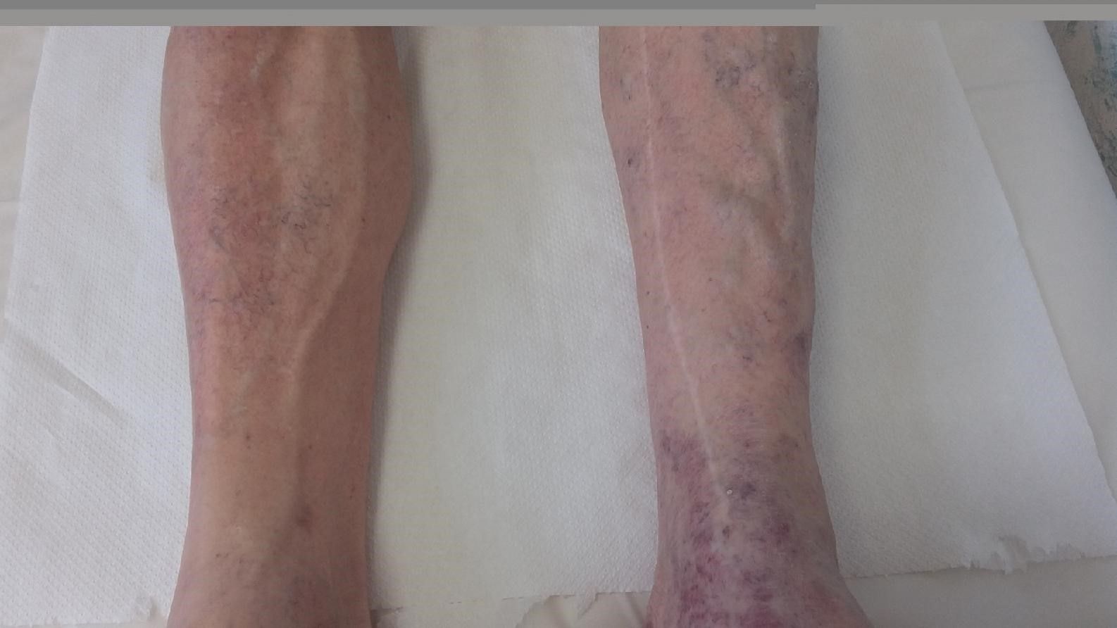 obrázek: Trombóza postihuje i mladé lidi. FN Plzeň upozorňuje na rizika