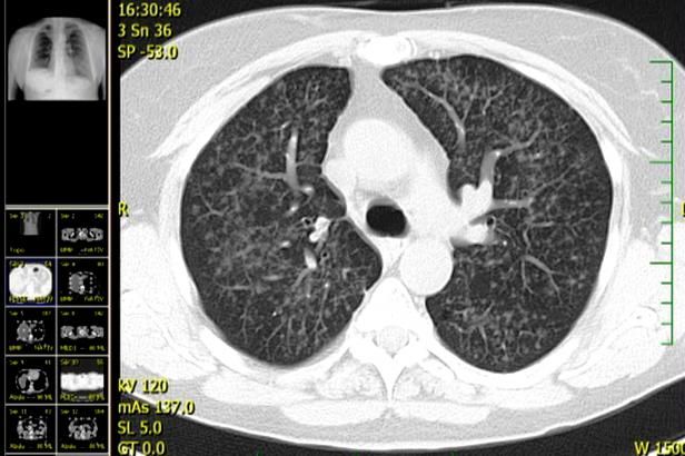 obrázek: Imunoterapie – nová éra v léčbě rakoviny plic, říkají lékaři