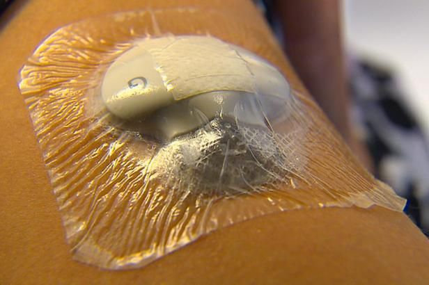 obrázek: Lidem s cukrovkou ulehčují život pumpy a chytré, ale drahé senzory