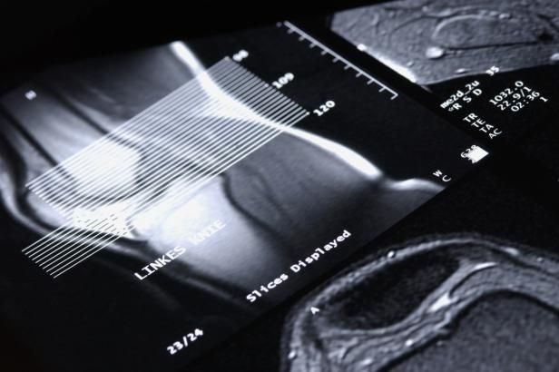 obrázek: Sportovci mohou jásat. Nová náhrada menisku umožňuje plnou zátěž