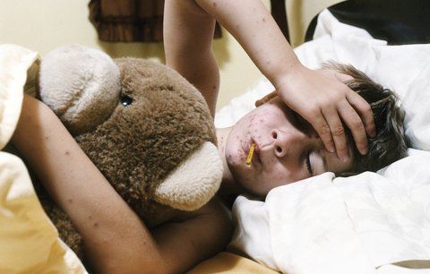 obrázek: Rodiče na Klatovsku pořádají neštovicové mejdany