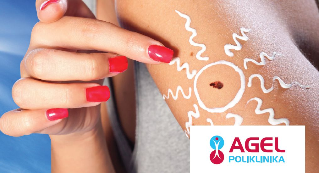 Zkontrolovat znaménka po létě je důležité. Celý měsíc je vyšetří Poliklinika AGEL Plzeň v rámci Měsíce prevence melanomu